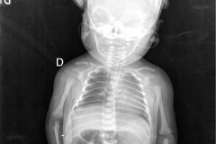 fractura-clavicula-001