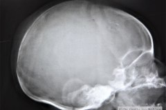 fractura-craneo-erosion-parietal-espatulas-002