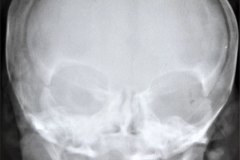 fractura-craneo-erosion-parietal-espatulas-004