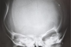 fractura-craneo-hundimiento-parietal-der-tac-1995-000