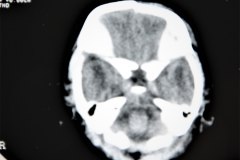 fractura-craneo-hundimiento-parietal-der-tac-1995-002