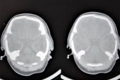 fractura-craneo-hundimiento-parietal-der-tac-1995-006