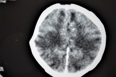 fractura-craneo-hundimiento-parietal-der-tac-1995-007