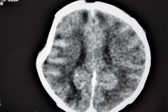 fractura-craneo-hundimiento-parietal-der-tac-1995-010