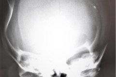 fractura-craneo-hundimiento-parietal-der-tac-1995-011