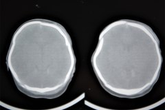 fractura-craneo-hundimiento-parietal-der-tac-1995-013