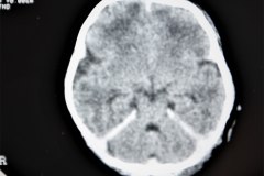fractura-craneo-hundimiento-parietal-der-tac-1995-015