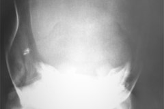 fractura-craneo-hundimiento-parietal-der-tac-1995-016