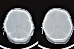 fractura-craneo-hundimiento-parietal-der-tac-1995-019