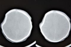 fractura-craneo-hundimiento-parietal-der-tac-1995-020