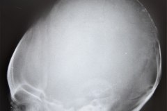 fractura-craneo-levantamiento-parietal-izq-cefalohematoma-1997-000