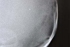 fractura-craneo-levantamiento-parietal-izq-cefalohematoma-1997-001