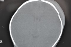 fractura-craneo-levantamiento-parietal-izq-cefalohematoma-1997-002