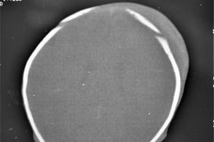 fractura-craneo-levantamiento-parietal-izq-cefalohematoma-1997-003