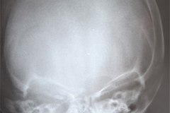 fractura-craneo-levantamiento-parietal-izq-cefalohematoma-1997-004
