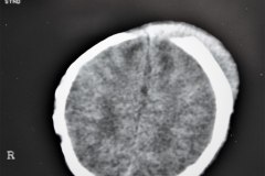fractura-craneo-levantamiento-parietal-izq-cefalohematoma-1997-005