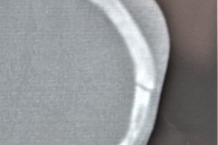 fractura-craneo-levantamiento-parietal-izq-cefalohematoma-1997-006