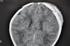 fractura-craneo-levantamiento-parietal-izq-cefalohematoma-1997-007