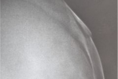 fractura-craneo-levantamiento-parietal-izq-cefalohematoma-1997-008
