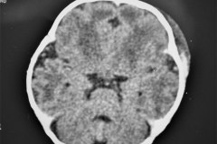 fractura-craneo-levantamiento-parietal-izq-cefalohematoma-1997-009