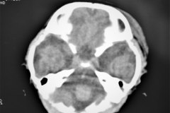 fractura-craneo-levantamiento-parietal-izq-cefalohematoma-1997-013
