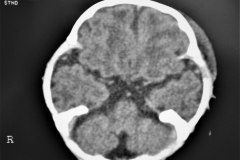 fractura-craneo-levantamiento-parietal-izq-cefalohematoma-1997-014