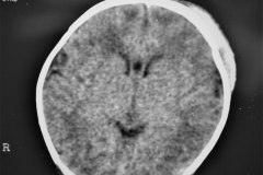 fractura-craneo-levantamiento-parietal-izq-cefalohematoma-1997-015