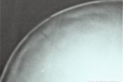 fractura-craneo-parietal-1987-000
