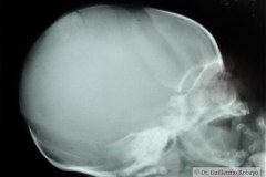 fractura-craneo-parietal-der-1995-001