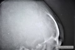 fractura-craneo-parietal-der-deprimida-1991-000