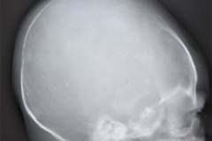 fractura-craneo-parietal-der-deprimida-1991-001