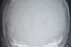 fractura-craneo-parietal-der-deprimida-1991-003