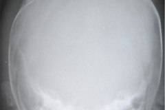 fractura-craneo-parietal-der-deprimida-1991-004