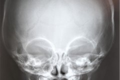 fractura-craneo-parietal-izq-1995-001