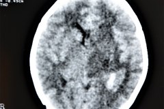 fractura-craneo-parietal-izq-hemorragia-intracraneal-hic-ventricular-izq-1997-001