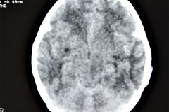 fractura-craneo-parietal-izq-hemorragia-intracraneal-hic-ventricular-izq-1997-004