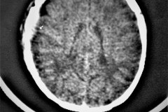 fractura-craneo-temporal-der-hematoma-epidural-1994-004