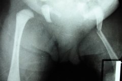 fractura-femur-izq-000