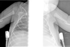 fractura-humero-bil-2007-004