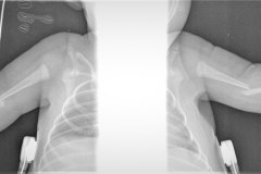 fractura-humero-bil-2007-005