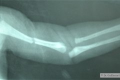 fractura-humero-izq-1987-000