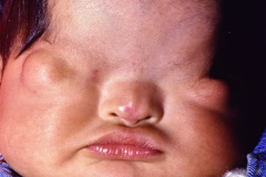 fraser-criptoftamia-1994-hno-2-001