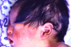 fraser-criptoftamia-criptorquidia-der-1993-000