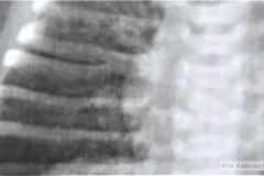 fusion-costal-costillas-4-5-000