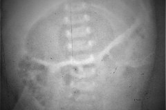gastroparesia-1985-000