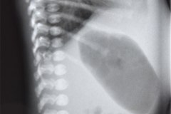 gastroparesia-1990-001