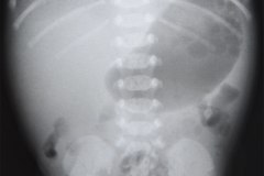 gastroparesia-1990-002