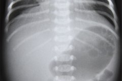 gastroparesia-1990-003