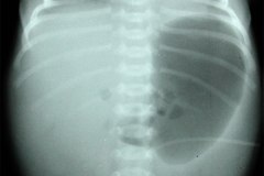 gastroparesia-1999-000