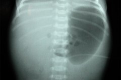 gastroparesia-1999-001
